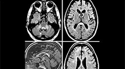 Fragile X Ataxia Syndrome Misdiagnosed As Multiple Sclerosis